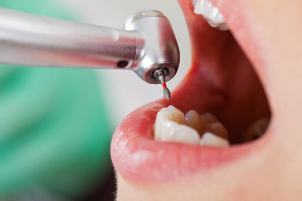 Best Emergency Treatment for Dental Infections or Abscesses in Bunk Foss, WA